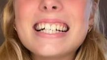 Inopro Teeth Whitening Strips
