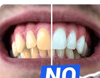wella white teeth whitening