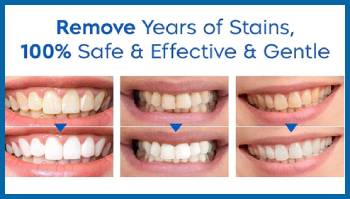Clevrmart Teeth Whitening Pen