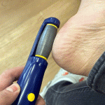 dr-scholl's-callus-remover-reviews