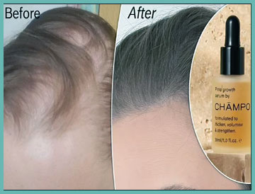 Chāmpo Pitta Growth Serum