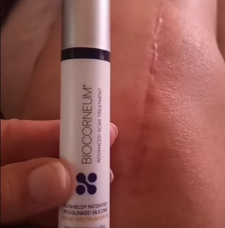 Skinuva Vs Biocorneum