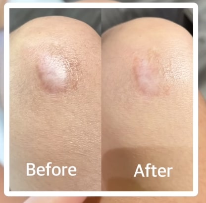 Silagen Vs Biocorneum