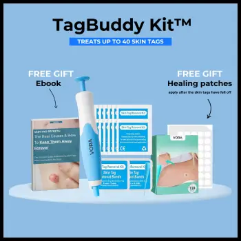 Tag Buddy Skin Tag Remover