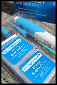 Tag Buddy Skin Tag Remover