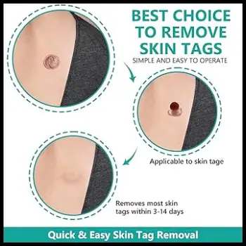 Tag Buddy Skin Tag Remover