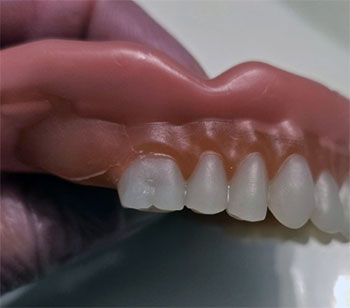 Boil and Bite Dentures