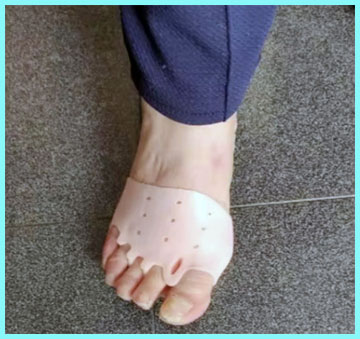 Hyggear Bunion Corrector