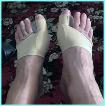 Hyggear Bunion Corrector