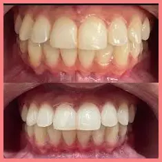 Shimmer Teeth Whitening Powder